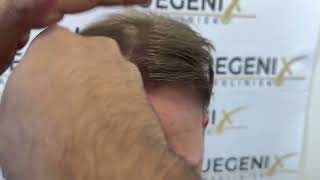 15 Month Result Hair Transplant  Dr Munib Ahmad FueGenix The Netherlands  Fine Light Blond [upl. by Gamali]