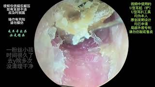 The ear canal is blocked with fungal dry patches [upl. by Bennir]