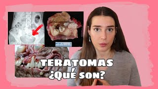 TERATOMA  un tumor peculiar [upl. by Une]