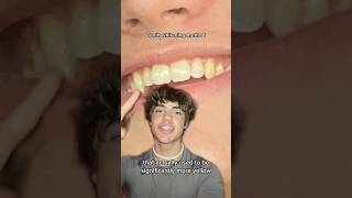 Dentist Reveals SHOCKING Teeth Whitening Secret 🤫🦷 [upl. by Falkner656]