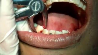 HUETEDENTAL Exodoncia de Premolares inferiores  34 y 44  Dr Rigoberto Huete [upl. by Yslehc26]