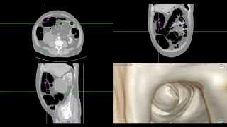 CT scan Abdominal Colonoscopy Navigated [upl. by Ainotna]