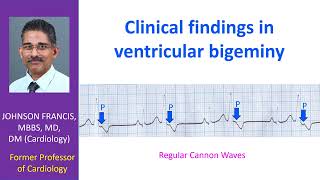 Ventricular Bigeminy and Clinical Findings [upl. by Ecenaj611]