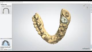 Form 3B  Solid Models with Working Dies in 3Shape Dental System [upl. by Sordnaxela]