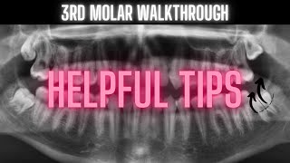 Third Molar Extraction Video  Helpful Tips  OnlineExodontiacom [upl. by Gnuhn925]