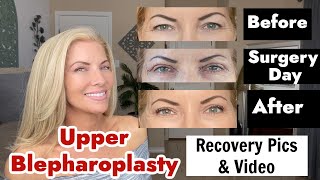 Upper Blepharoplasty Eyelid Surgery  Recovery Pics and Videos  Before amp Afters [upl. by Latsryk]