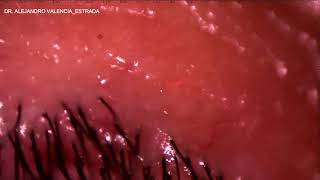 IRIDOTOMIA YAG LASER [upl. by Chura]