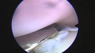 Elbow arthroscopy in a dog with FCP and Incongruency [upl. by Ainesell]