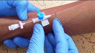 IV CANNULATION TECHNIQUE  LEARN THE BEST TECHNIQUE  STEP BY STEP [upl. by Neyud536]