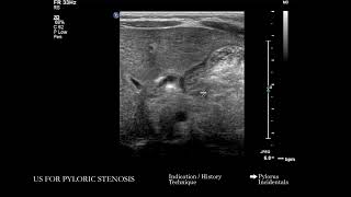 US Ultrasound for Pyloric Stenosis  Search Pattern [upl. by Oinolopa]