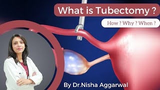 What Is Tubectomy  By DrNisha Aggarwal  How  Why  When   Female Sterilisation [upl. by Sybyl]