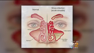 Doctor Tried And True Methods For Sinus Relief Are Still Best [upl. by Iohk]