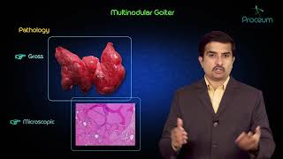 Multinodular goitre  Usmle step 1 pathology lecture and case presentation [upl. by Barbour]