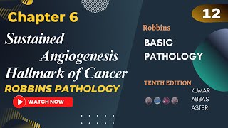 Sustained Angiogenesis Hallmark of Cancer Neoplasia Lecture 12 Robbins Pathology [upl. by Marriott]