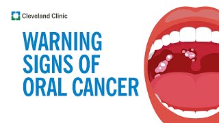 How to Screen Yourself for Oral Cancer [upl. by Naitsihc522]