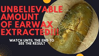 UNBELIEVABLE Amount Of Earwax Extracted From This Ear Watch Until The End [upl. by Nakasuji]