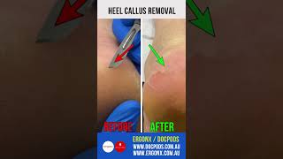 Heel Callus Removal [upl. by Lavina]