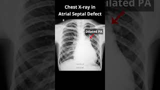 Chest Xray Part 2 in Atrial septal defect ASD shorts asd cxr [upl. by Ateuqahs598]