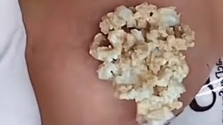 Pimples huge blackheads and pimple poppingbest pimple popping video [upl. by Ogait204]