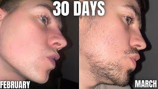 INSANE Beard growth in only 30 Days using MINOXIDIL and DERMA ROLLING [upl. by Ahseei142]