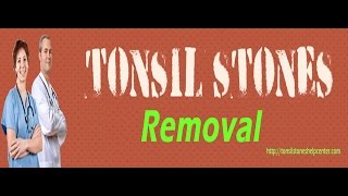 Natural Tonsil Stone Removal Within Just 4 Weeks [upl. by Bronez]