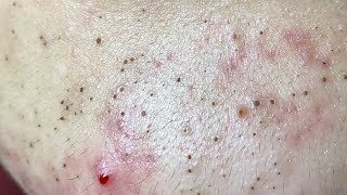 Acne Treatment Huong Da Nang The video has been lost for a long time Remove Blackheads [upl. by Gauntlett176]