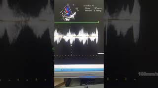 Case54 echocardiography  TOF with absent Pulmonary Valve [upl. by Notrem397]