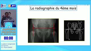 Luxation congénitale de hanche  Dr Pierre MARY  JIPT Maroc 2023 Partie 2 [upl. by Sikleb77]