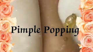 Pimple amp Blackheads Popping  27 [upl. by Zaob311]