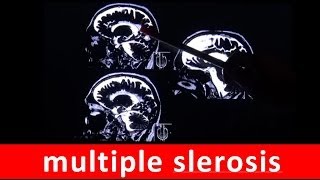 multiple sclerosis MS chronic autoimmune disease in MRI scan by RadiologyTV [upl. by Affrica]