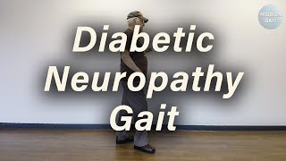 Diabetic Neuropathy Gait [upl. by Michelsen917]