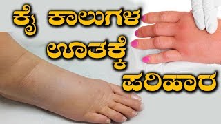 Edema Treatment  How To Cure Swelling In Hands amp Legs  ನೀರು ತುಂಬಿಕೊಂಡು ಮೈ ಕೈ ಊತ ನಿವಾರಣೆ ಹೇಗೆ [upl. by Woodall675]