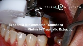 Exodontia Minimamente Traumática  Minimally Traumatic Extraction [upl. by Llewen539]