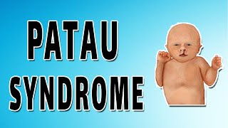 Patau Syndrome [upl. by Gnod667]