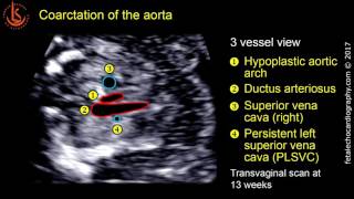 Fetal echocardiography at 1113 weeks Coarctation of the Aorta CoA [upl. by Schreibman784]