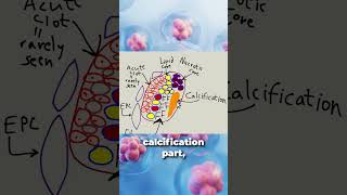 Is atherosclerosis reversible [upl. by Greenfield]