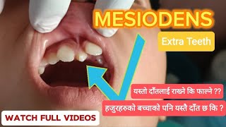 🇳🇵Mesiodens Extra TeethSupernumerary Tooth Extraction By ForcepChild Patient DrSwostik Devkota [upl. by Neelyahs887]