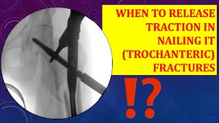 Traction release in trochanteric IT fracture nailining WHEN amp HOW MUCH [upl. by Anitsim]