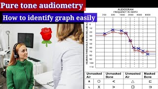 Pure tone Audiometry Graph 📊 🔴conductive hearing loss Sensorineural hearing loss Mixed hearing [upl. by Arianna]