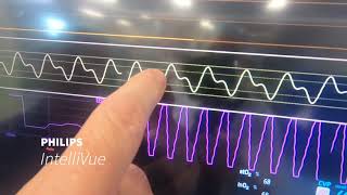 Intro and Demo of Philips IntelliVue [upl. by Savihc]