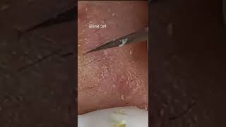 Pickel Ausdrücken Blackheads Akne amp Mitesser entfernen 🔴 18 [upl. by Chaves]