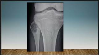 Short Case Discussion  Chondroblastoma  fibula [upl. by Tiraj]