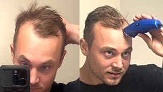 SHAVING OFF MY BALDINGRECEDING HAIR [upl. by Nandor]