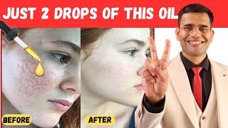 Just 2 drops of this magical oil to Get Rid of Acne Scars  Dr Vivek Joshi [upl. by Hardy]