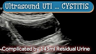 Cystitis  UTI  Ultrasound  Diagnosis [upl. by Nujra]