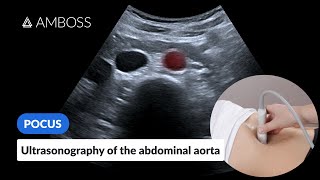 Point of Care Ultrasound of the Abdominal Aorta  AMBOSS Video [upl. by Ophelie]