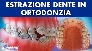 Estrazione dente in ortodonzia © [upl. by Aiderfla]