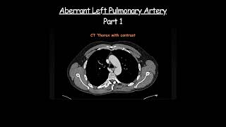 Aberrant Left Pulmonary Artery Part 1 radiology radiologist anatomy [upl. by Anicul995]