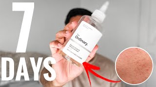 I Used THE ORDINARY 7 GLYCOLIC ACID For 7 Days Here’s What Happened [upl. by Lleumas735]