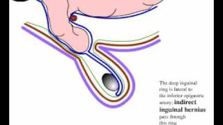 Direct and indirect inguinal hernia [upl. by Kyd]